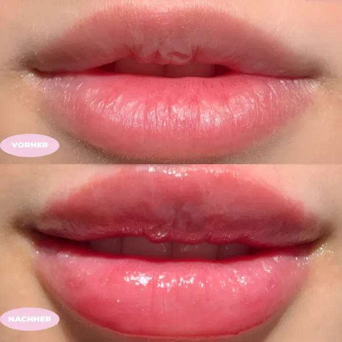 Voraal| lip filler kit hyaluronzuur als geschenk